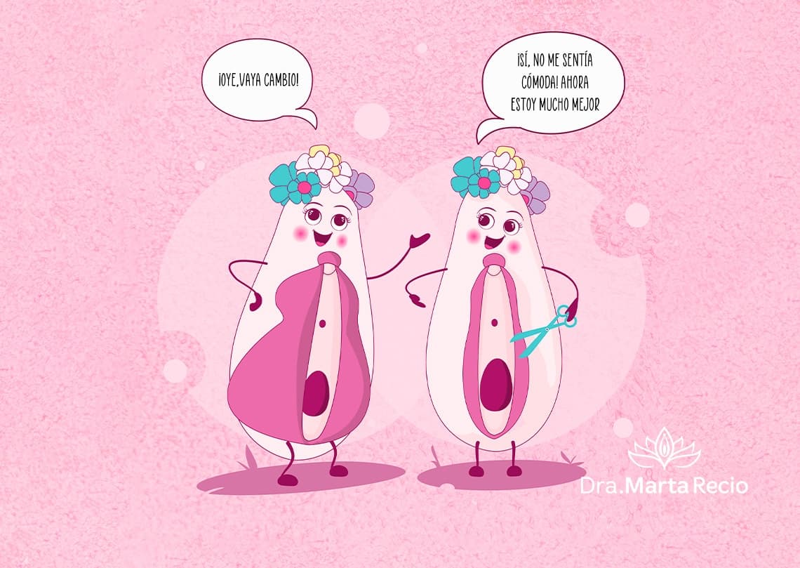 Ilustración de la labioplastia