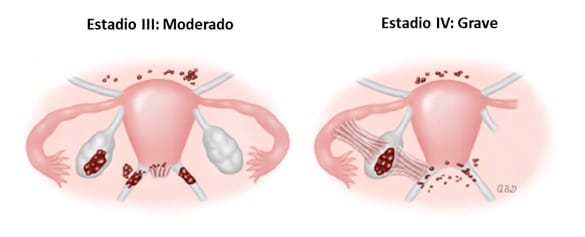 Estadios de la Endometriosis: III y IV