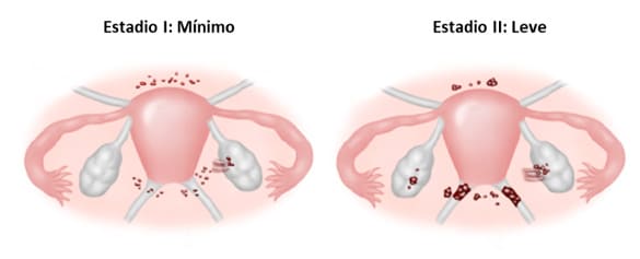 estadios 1 y 2 de la endometriosis