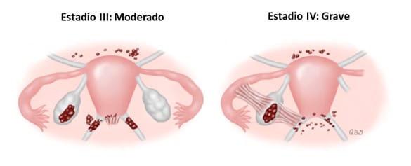 estadios 3 y 4 de la endometriosis